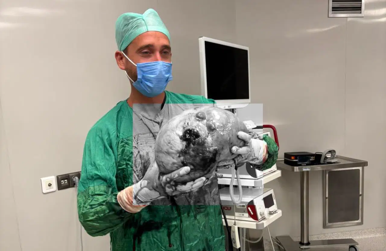 Karın Ağrısıyla Gitti Doktorlar Gördüklerine İnanamadı