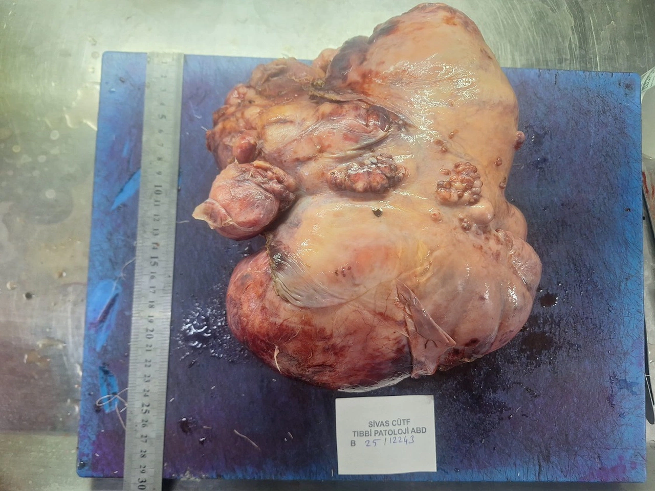 Sivas'ta göğüs kafesinden çıkan dev tümör şaşırttı