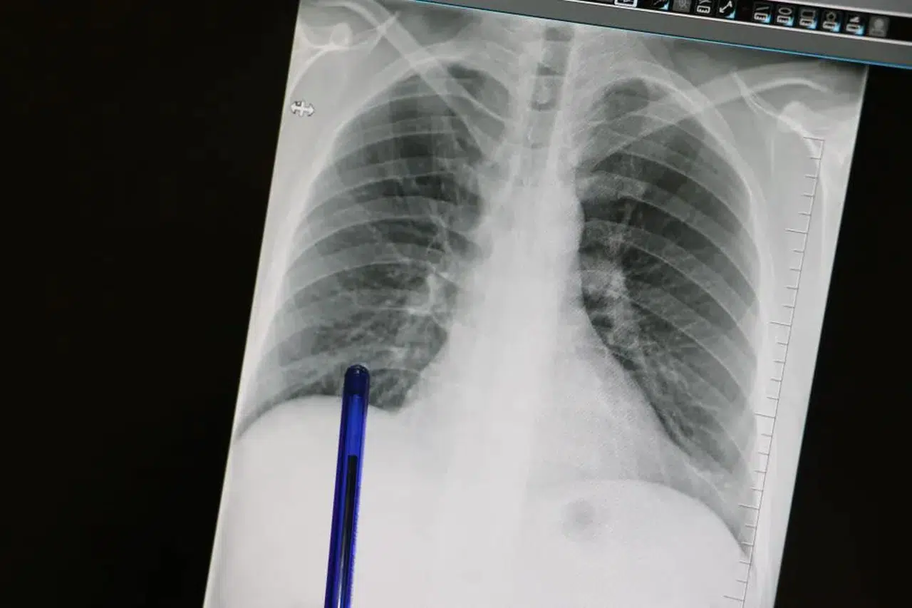 Basit Öksürük Akciğer Kanseri Habercisi Olabilir! Kimler Taramadan Geçmeli?