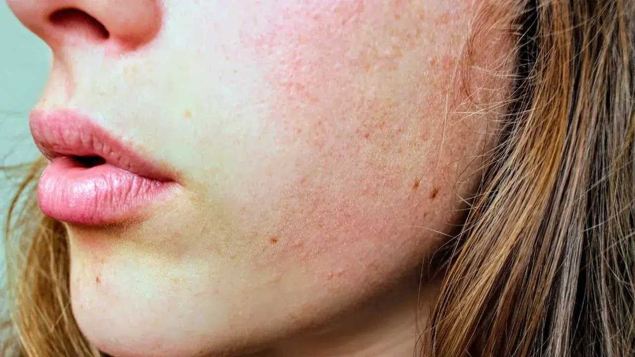 Kış Mevsiminde Bu Cilt Hastalıkları Daha Sık Görülüyor!