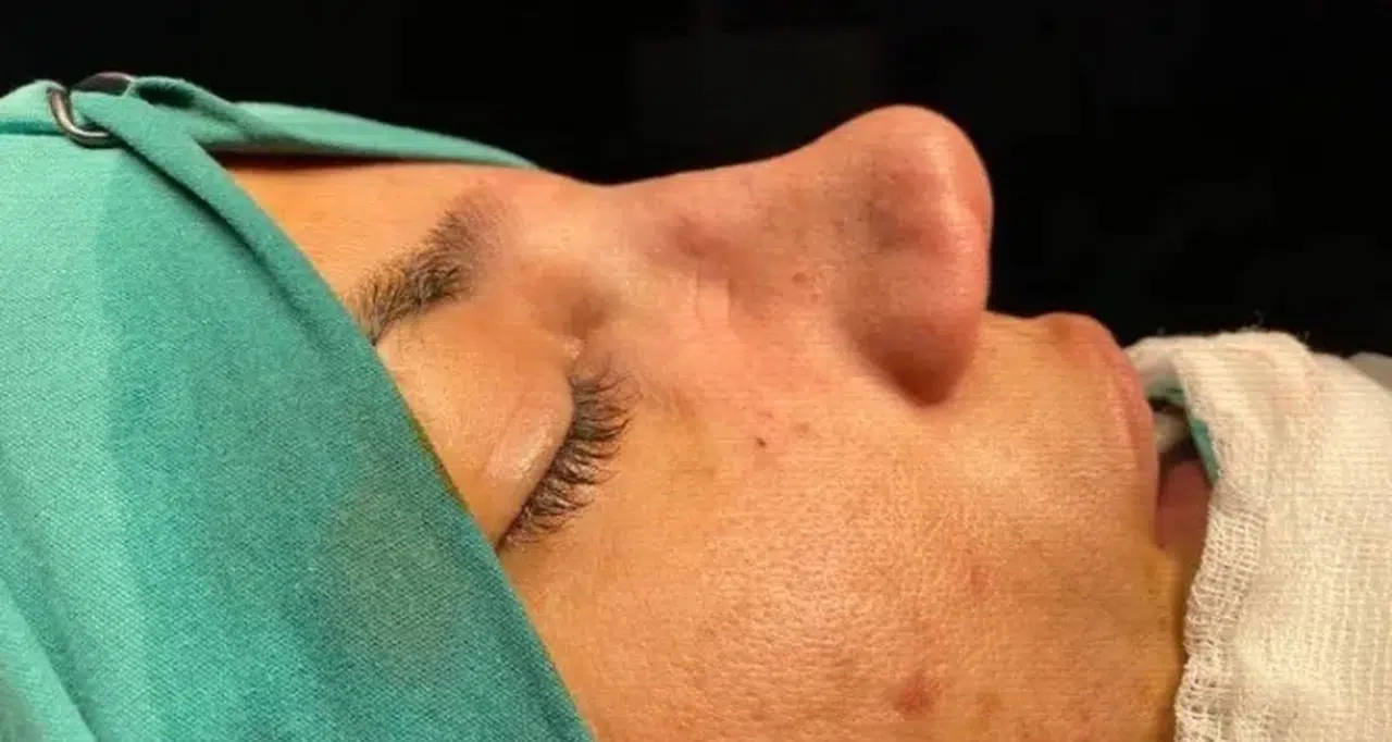 Kusursuz Burun İçin Altın Oran Efsanesi Bitiyor Mu? Ameliyat Masasına Yatmadan Önce Mutlaka Okuyun