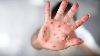 Ebeveynler Dikkat! Sadece Bir Döküntü Deyip Geçmeyin!