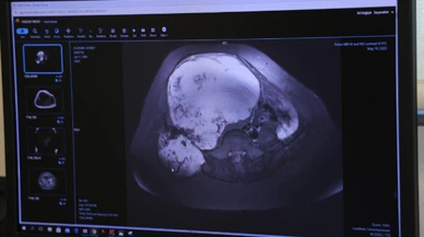 Doğum Sırasında Fark Edilen Tümör, 6 Saatlik Süren Ameliyatla Alındı