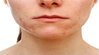 Kaşıntı öksürük döküntü varsa dikkat