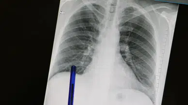 Basit Öksürük Akciğer Kanseri Habercisi Olabilir! Kimler Taramadan Geçmeli?