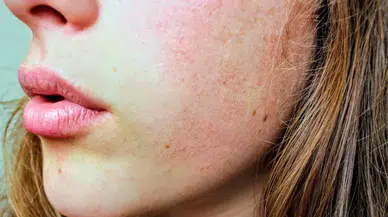 Kış Mevsiminde Bu Cilt Hastalıkları Daha Sık Görülüyor!