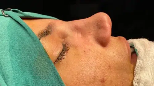 Kusursuz Burun İçin Altın Oran Efsanesi Bitiyor Mu? Ameliyat Masasına Yatmadan Önce Mutlaka Okuyun